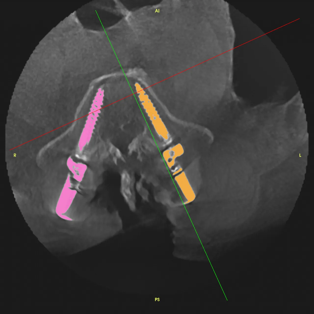 Sezione assiale della vertebra con le due viti peduncolari evidenziate